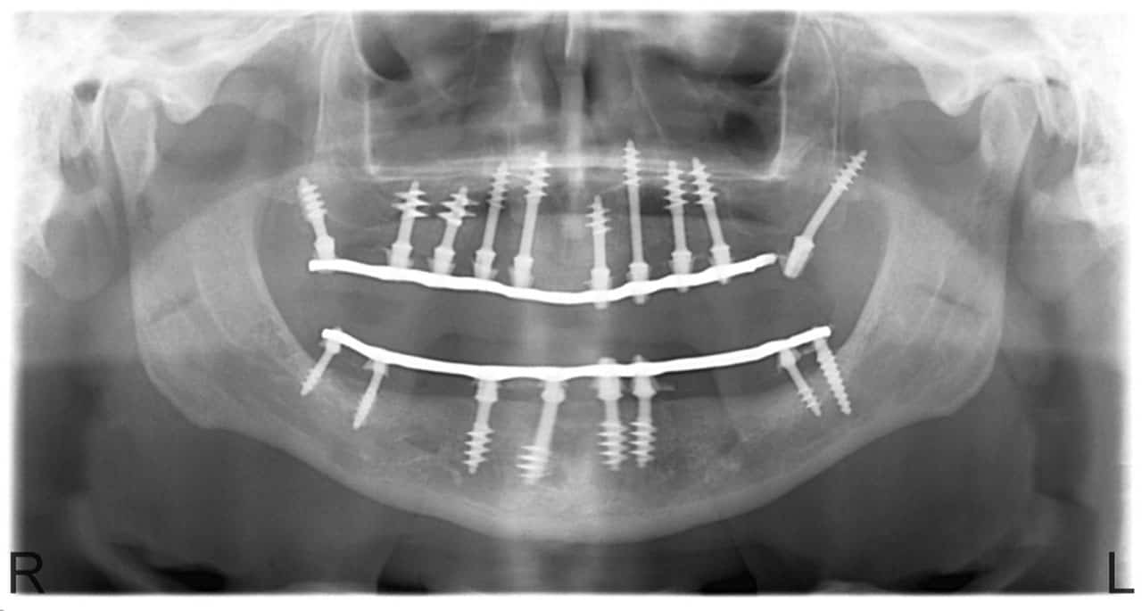 A fog implantátum bekerülésének szakaszai